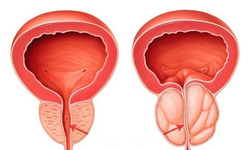 Healthy prostate and inflamed with prostate